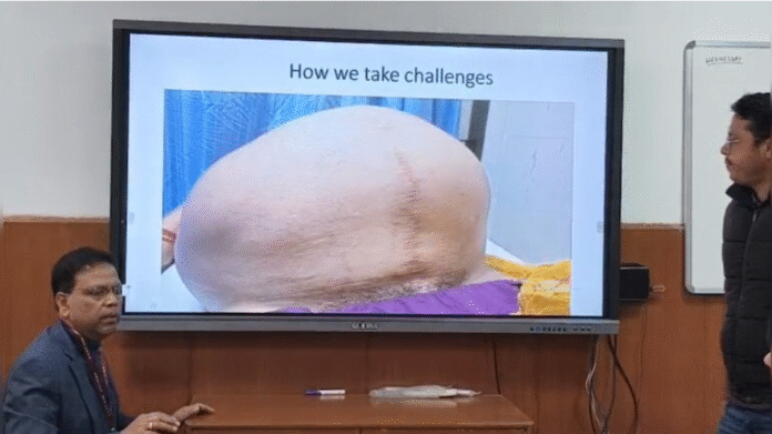 AIIMS दिल्ली में मेडिकल चमत्कार, महिला के पेट से निकाला गया 19.9 किलो का विशाल ट्यूमर